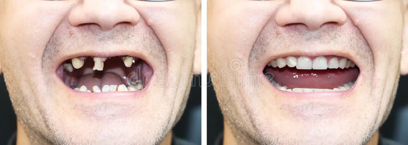 Restauración Dental Smile®